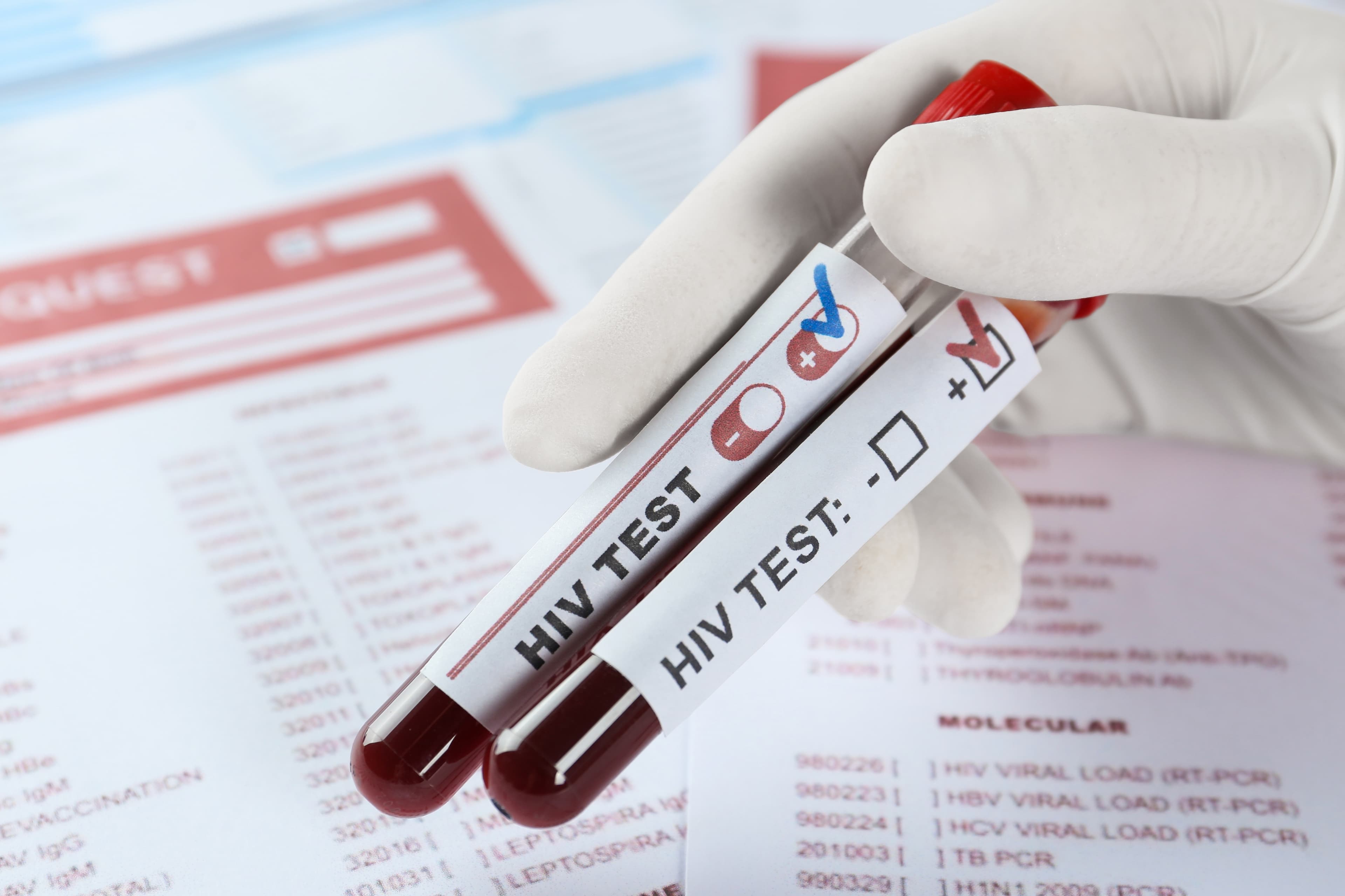 The Difference Between HIV and AIDS: Breaking Down the Basics